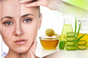 remedios caseros para combatir el acne