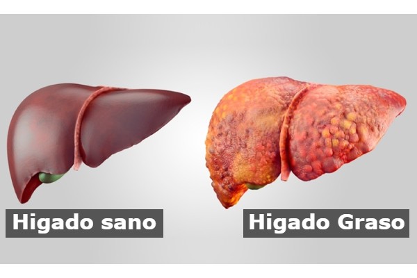 dietas para el higado