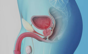 como desinflamar la prostata rapidamente