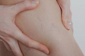 como eliminar las arañitas con remedios caseros