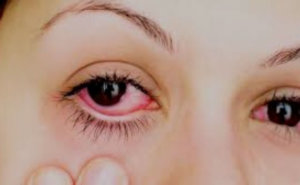 Remedios caseros para los ojos irritados