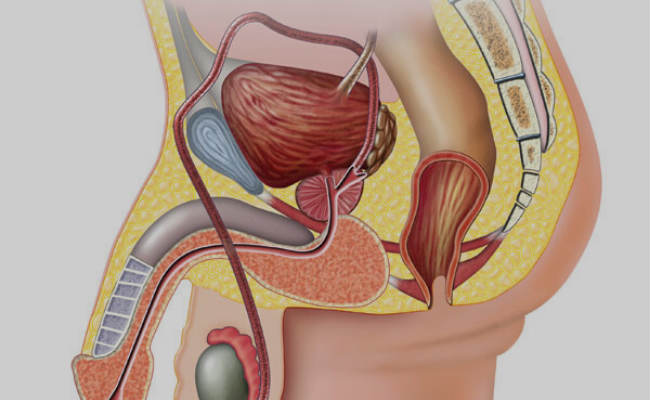 remedios caseros para la prostata