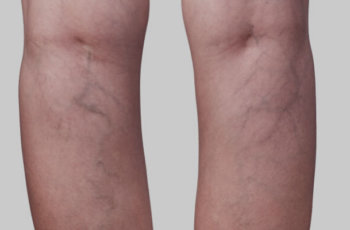 remedios caseros para las varices inflamadas