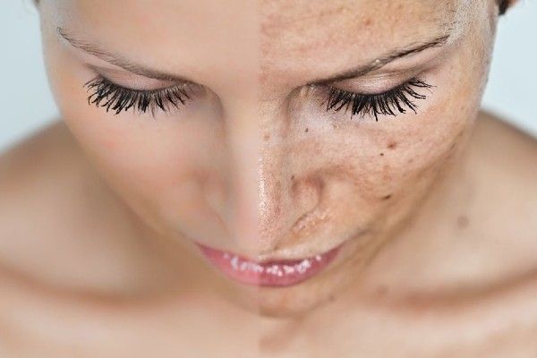 como eliminar las manchas de la cara de forma natural